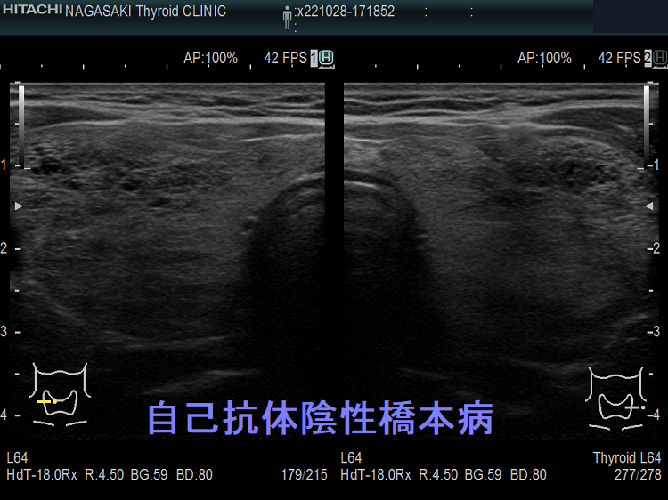 自己抗体陰性橋本病 自己抗体陰性橋本病