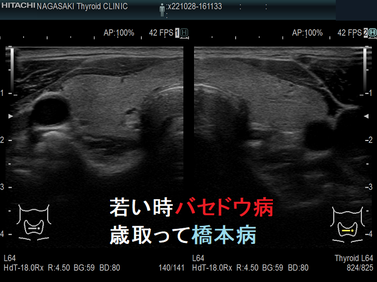 若い時バセドウ病、歳取って橋本病 若い時バセドウ病、歳取って橋本病