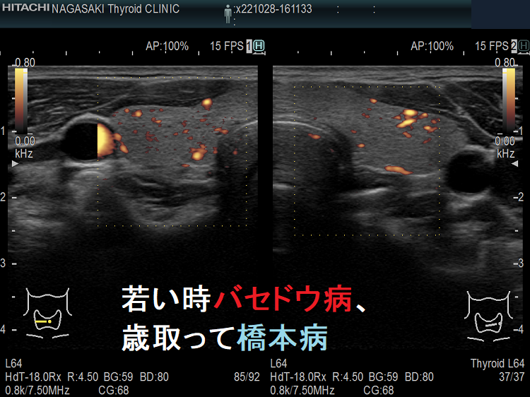 若い時バセドウ病、歳取って橋本病 超音波(エコー)画像 ドプラーモード 若い時バセドウ病、歳取って橋本病 超音波(エコー)画像 ドプラーモード