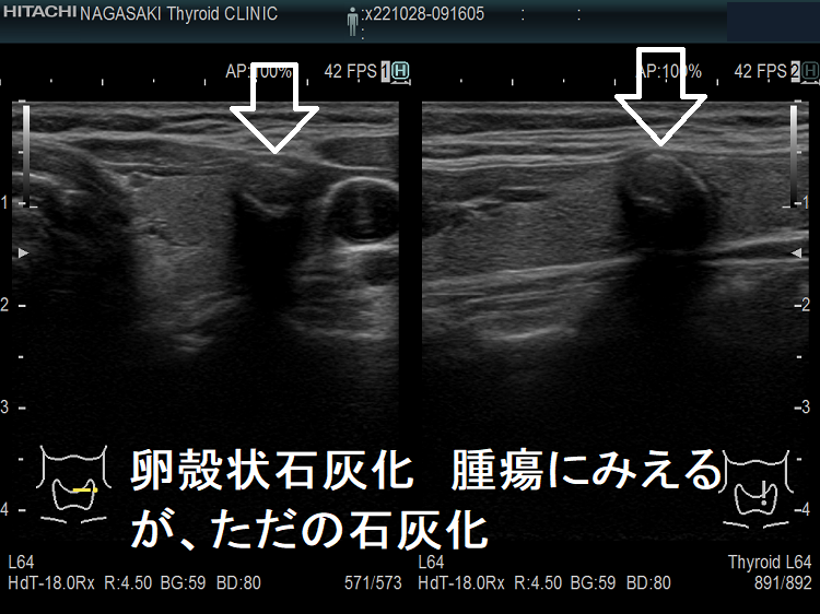 卵殻状石灰化 腫瘍にみえるが、ただの石灰化 卵殻状石灰化 腫瘍にみえるが、ただの石灰化