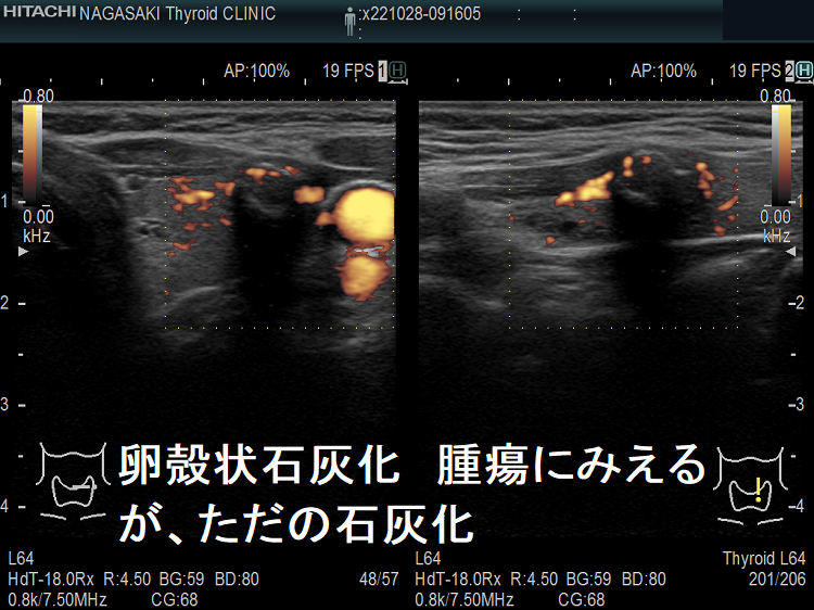 殻状石灰化 腫瘍にみえるが、ただの石灰化 超音波(エコー)画像 ドプラーモード 殻状石灰化 腫瘍にみえるが、ただの石灰化 超音波(エコー)画像 ドプラーモード