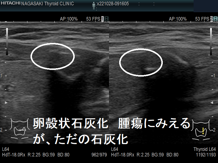 卵殻状石灰化 腫瘍にみえるが、ただの石灰化 超音波(エコー)画像(拡大) 卵殻状石灰化 腫瘍にみえるが、ただの石灰化 超音波(エコー)画像(拡大)
