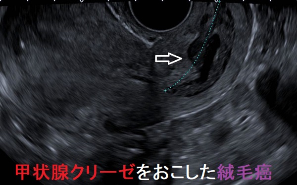 甲状腺クリーゼをおこした絨毛癌 甲状腺クリーゼをおこした絨毛癌