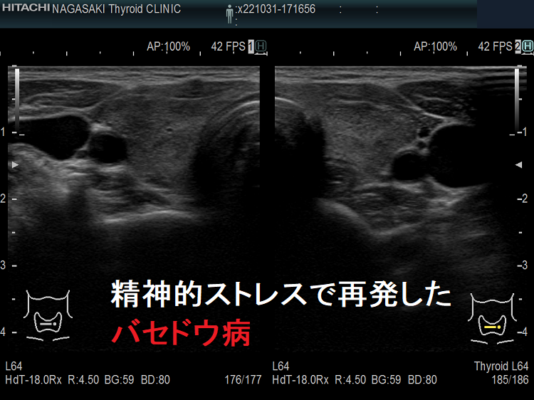ストレスで再発したバセドウ病 ストレスで再発したバセドウ病