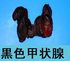 黒色甲状腺2 黒色甲状腺2