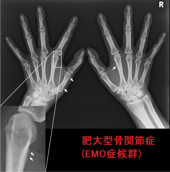 肥大型骨関節症(EMO症候群) 手関節X線像 肥大型骨関節症(EMO症候群) 手関節X線像