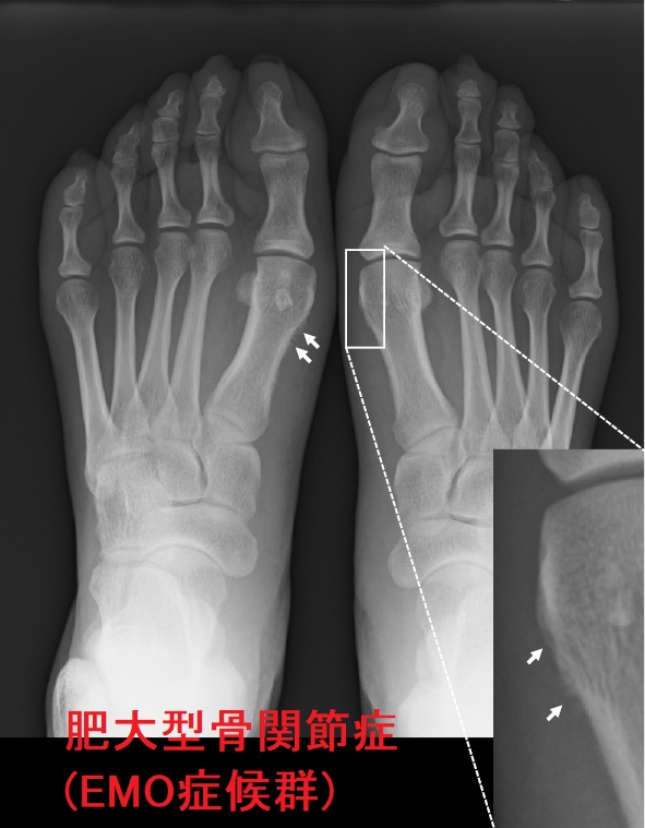 肥大型骨関節症(EMO症候群) 足関節X線像 肥大型骨関節症(EMO症候群) 足関節X線像