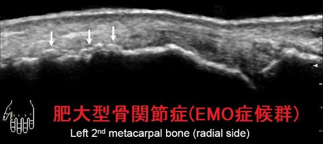 肥大型骨関節症(EMO症候群) 手関節エコー 肥大型骨関節症(EMO症候群) 手関節エコー