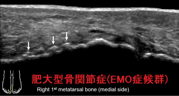 肥大型骨関節症(EMO症候群) 足関節エコー 肥大型骨関節症(EMO症候群) 足関節エコー
