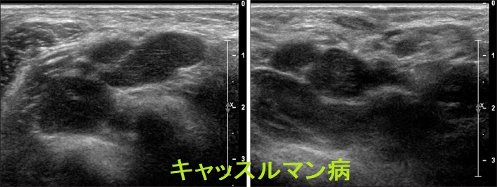 キャッスルマン病 超音波(エコー)画像2 キャッスルマン病 超音波(エコー)画像2