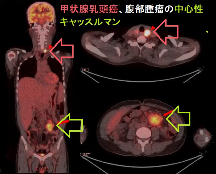 甲状腺乳頭癌、腹部腫瘤の多中心性キャッスルマン病、頭蓋骨の成人ランゲルハンス細胞組織球症の合併 甲状腺乳頭癌、腹部腫瘤の中心性キャッスルマン病、頭蓋骨の成人ランゲルハンス細胞組織球症の合併