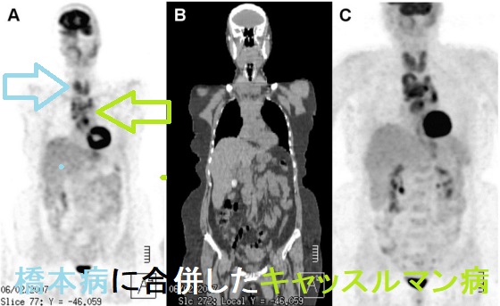 橋本病に合併したキャッスルマン病 PET-CT画像 橋本病に合併したキャッスルマン病 PET-CT画像
