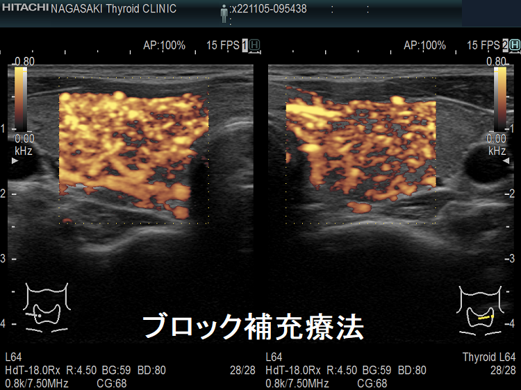 長崎甲状腺クリニック(大阪)でブロック補充療法中の甲状腺機能亢進症/バセドウ病 ドプラーモード 長崎甲状腺クリニック(大阪)でブロック補充療法中の甲状腺機能亢進症/バセドウ病 ドプラーモード