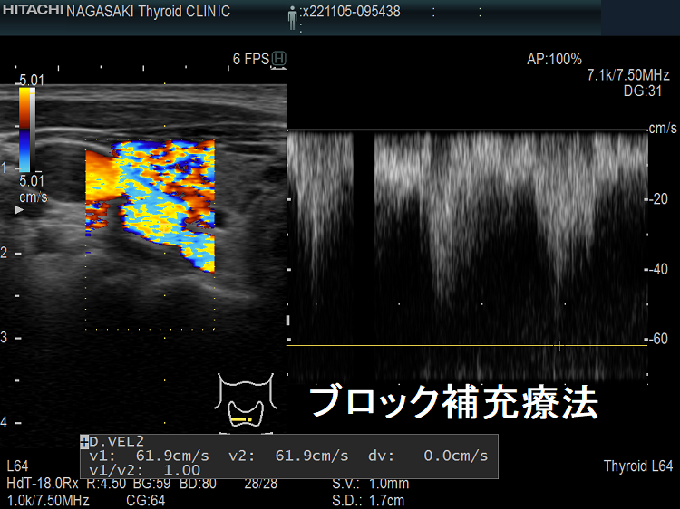 長崎甲状腺クリニック(大阪)でブロック補充療法中の甲状腺機能亢進症/バセドウ病 下甲状腺動脈血流速度(ITA-PSV) 長崎甲状腺クリニック(大阪)でブロック補充療法中の甲状腺機能亢進症/バセドウ病 下甲状腺動脈血流速度(ITA-PSV)