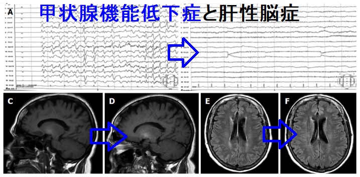 甲状腺機能低下症と肝性脳症 甲状腺機能低下症と肝性脳症