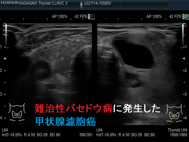難治性バセドウ病に発生した甲状腺濾胞癌 難治性バセドウ病に発生した甲状腺濾胞癌