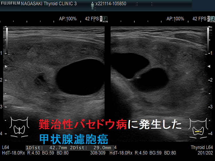 難治性バセドウ病に発生した甲状腺濾胞癌2 難治性バセドウ病に発生した甲状腺濾胞癌2