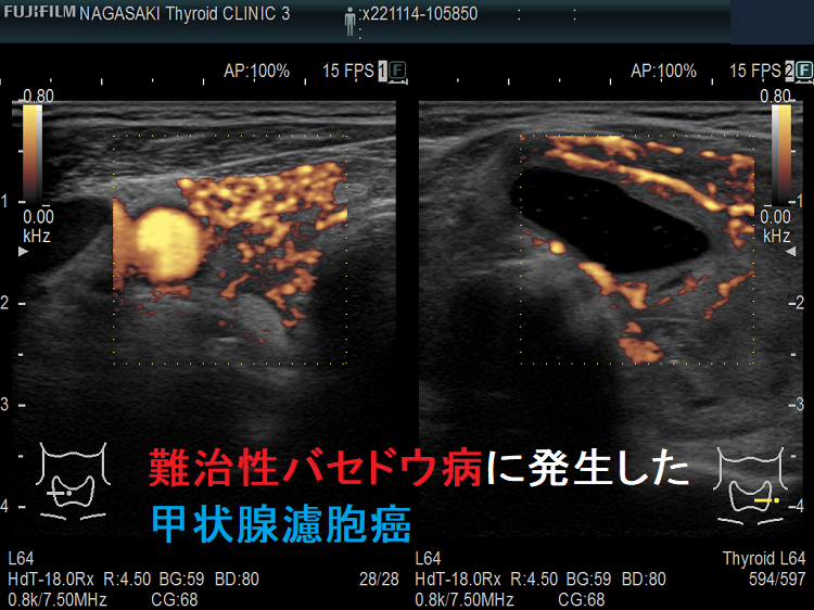 難治性バセドウ病に発生した甲状腺濾胞癌3 難治性バセドウ病に発生した甲状腺濾胞癌3