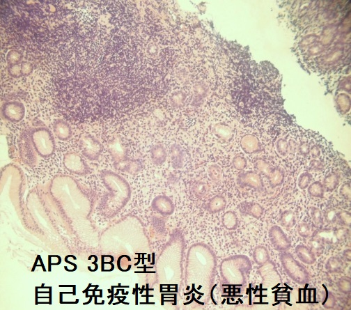 APS(多腺性自己免疫症候群)3BC型 自己免疫性胃炎(悪性貧血) APS(多腺性自己免疫症候群)3BC型 自己免疫性胃炎(悪性貧血)