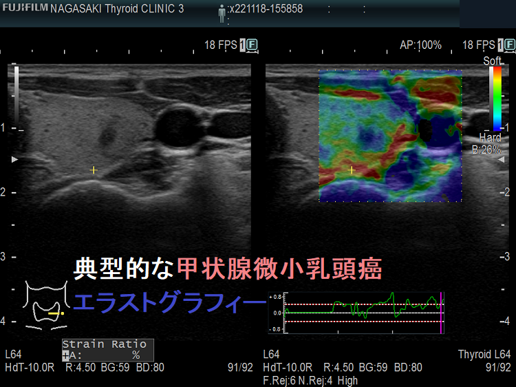 典型的な甲状腺微小乳頭癌 エラストグラフィー 典型的な甲状腺微小乳頭癌 エラストグラフィー