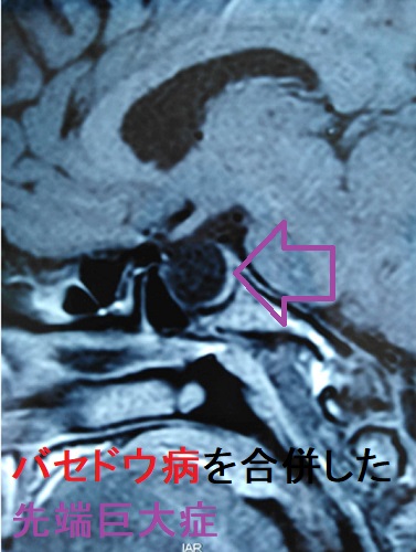 先端巨大症（成長ホルモン産生下垂体神経内分泌腫瘍）と甲状腺