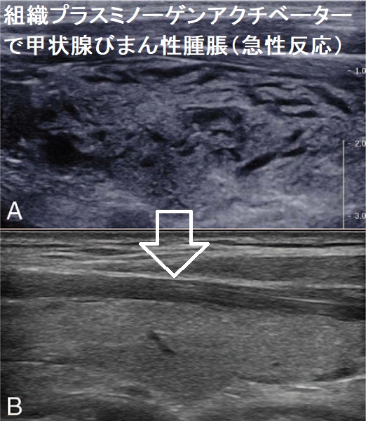 組織プラスミノーゲンアクチベーターで甲状腺びまん性腫脹(急性反応) 組織プラスミノーゲンアクチベーターで甲状腺びまん性腫脹(急性反応)