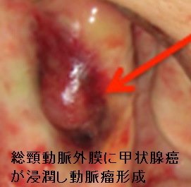 総頸動脈外膜に甲状腺癌が浸潤し動脈瘤形成 総頸動脈外膜に甲状腺癌が浸潤し動脈瘤形成