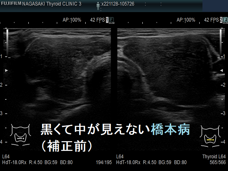 黒くて中が見えない橋本病 補正前 (水平断) 黒くて中が見えない橋本病 補正前 (水平断)