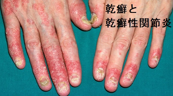 乾癬と甲状腺 乾癬と甲状腺