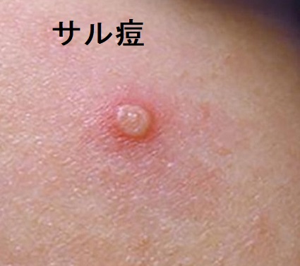 サル痘1 サル痘1