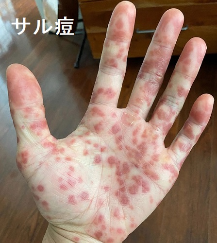 サル痘2 サル痘2