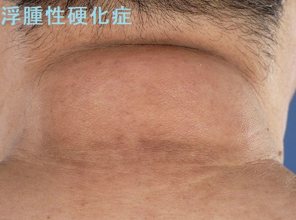 浮腫性硬化症 浮腫性硬化症