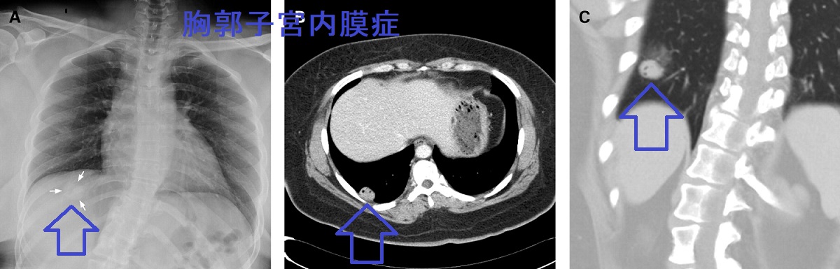 胸郭子宮内膜症 胸郭子宮内膜症
