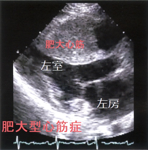肥大型心筋症 肥大型心筋症
