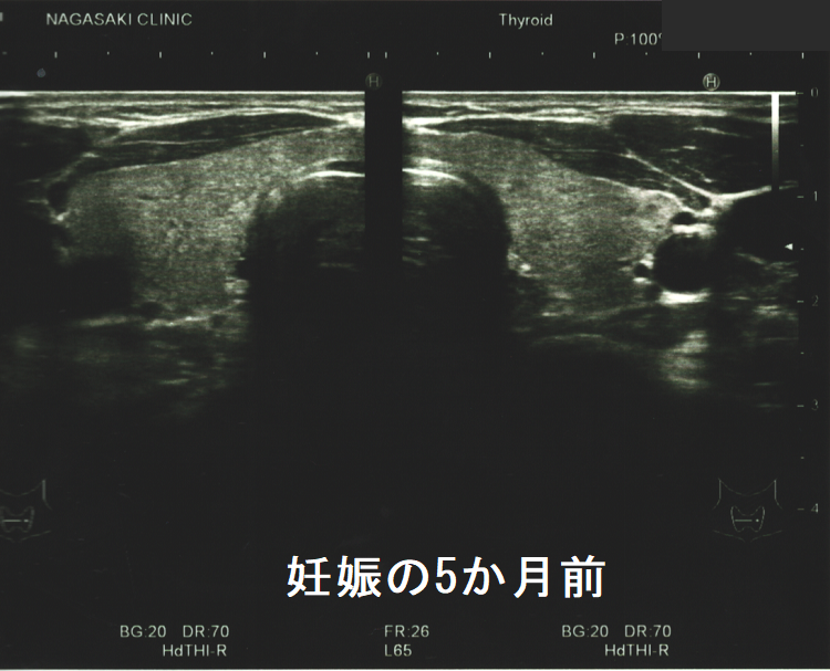 妊娠の5か月前 甲状腺(水平断) 妊娠の5か月前 甲状腺(水平断)