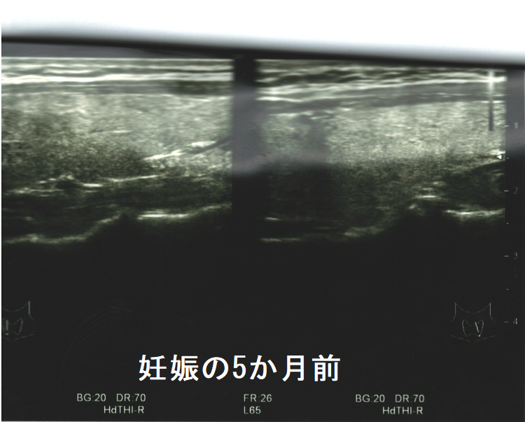妊娠の5か月前 甲状腺(垂直断) 妊娠の5か月前 甲状腺(垂直断)