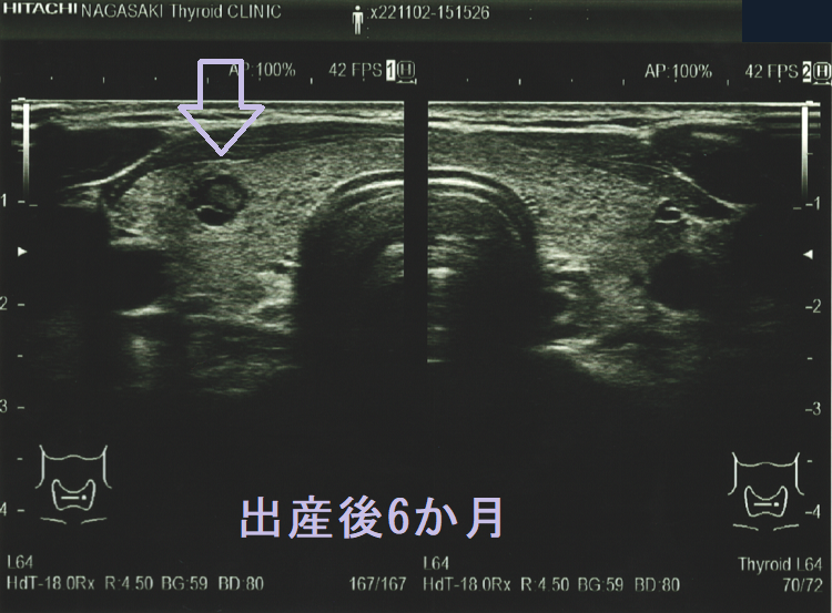 出産後6か月に見つかった甲状腺微小乳頭癌 出産後6か月に見つかった甲状腺微小乳頭癌