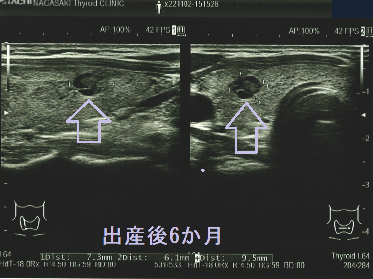 出産後6か月に見つかった甲状腺微小乳頭癌2 出産後6か月に見つかった甲状腺微小乳頭癌2
