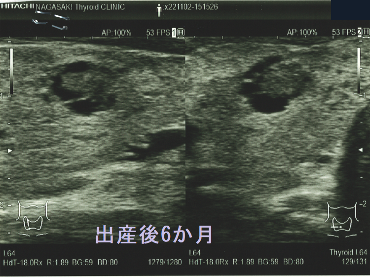 出産後6か月に見つかった甲状腺微小乳頭癌(拡大) 出産後6か月に見つかった甲状腺微小乳頭癌(拡大)