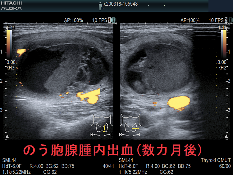 のう胞腺腫内出血(数カ月後) 超音波(エコー)画像 ドプラーモード のう胞腺腫内出血(数カ月後) 超音波(エコー)画像 ドプラーモード