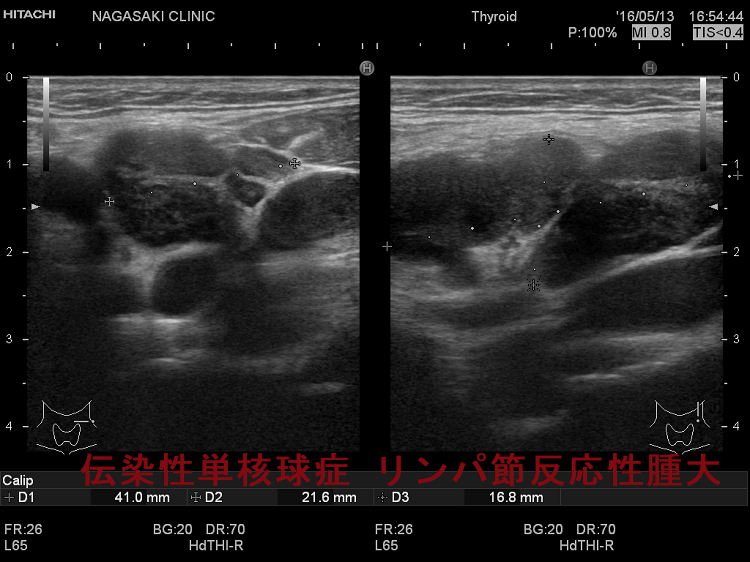 伝染性単核球症 リンパ節反応性腫大 超音波(エコー)画像 伝染性単核球症 リンパ節反応性腫大 超音波(エコー)画像
