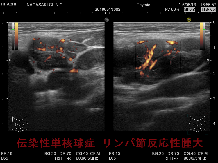 伝染性単核球症 リンパ節反応性腫大 超音波(エコー)画像 ドプラーモード 伝染性単核球症 リンパ節反応性腫大 超音波(エコー)画像 ドプラーモード