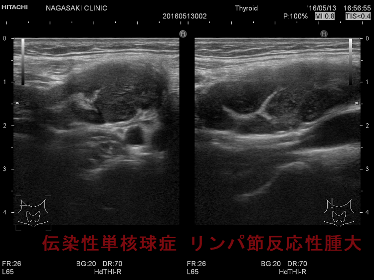 伝染性単核球症 リンパ節反応性腫大 超音波(エコー)画像 2 伝染性単核球症 リンパ節反応性腫大 超音波(エコー)画像 2