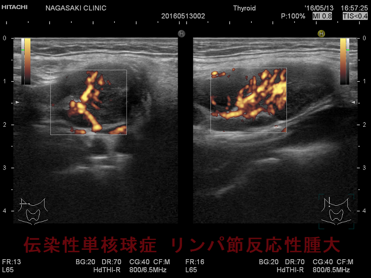 伝染性単核球症 リンパ節反応性腫大 超音波(エコー)画像 ドプラーモード 2 伝染性単核球症 リンパ節反応性腫大 超音波(エコー)画像 ドプラーモード 2