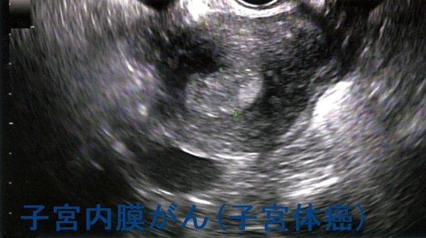 子宮内膜がん(子宮体癌) 経腟超音波像 子宮内膜がん(子宮体癌) 経腟超音波像