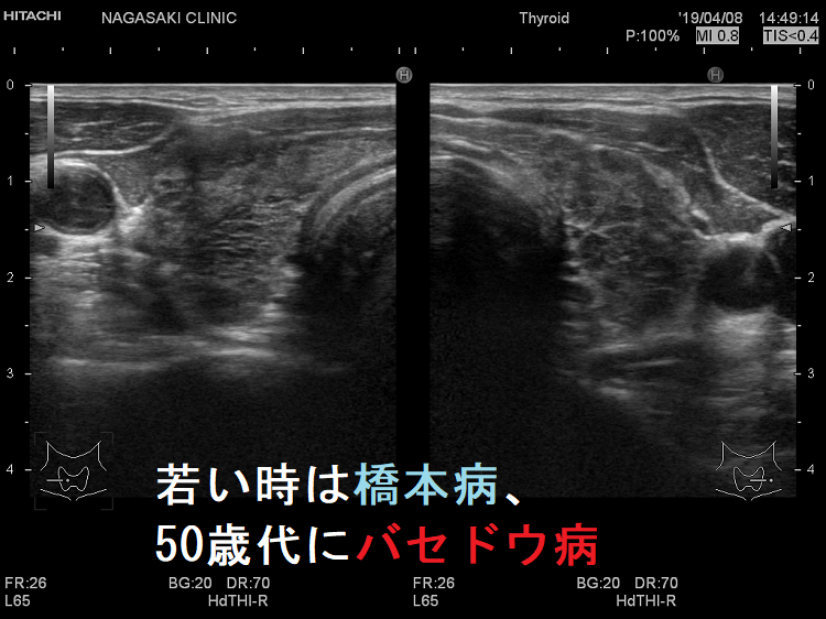 若い時は橋本病、50歳代にバセドウ病 若い時は橋本病、50歳代にバセドウ病
