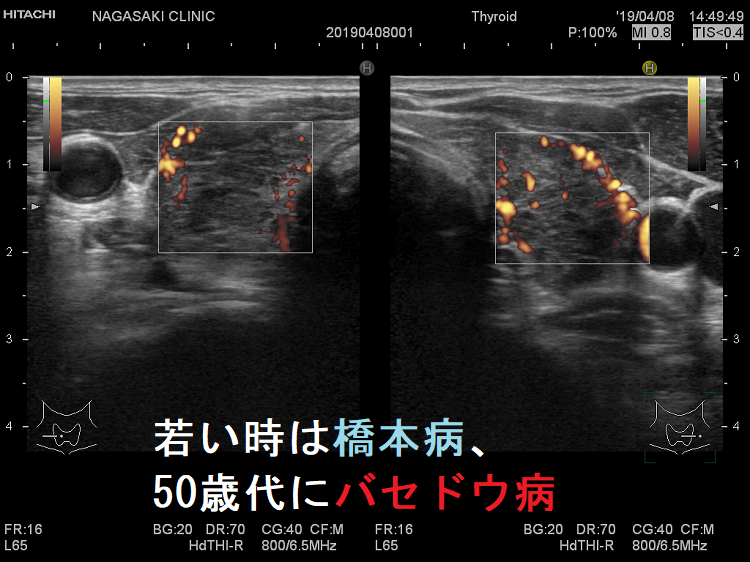 若い時は橋本病、50歳代にバセドウ病 ドプラーモード 若い時は橋本病、50歳代にバセドウ病 ドプラーモード