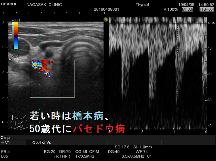 若い時は橋本病、50歳代にバセドウ病 ITA-PSV 若い時は橋本病、50歳代にバセドウ病 ITA-PSV