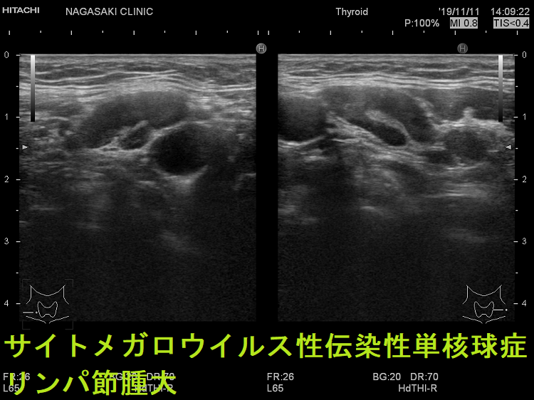 サイトメガロウイルス性伝染性単核球症 リンパ節腫大(水平断) 超音波(エコー)画像 サイトメガロウイルス性伝染性単核球症 リンパ節腫大(水平断) 超音波(エコー)画像
