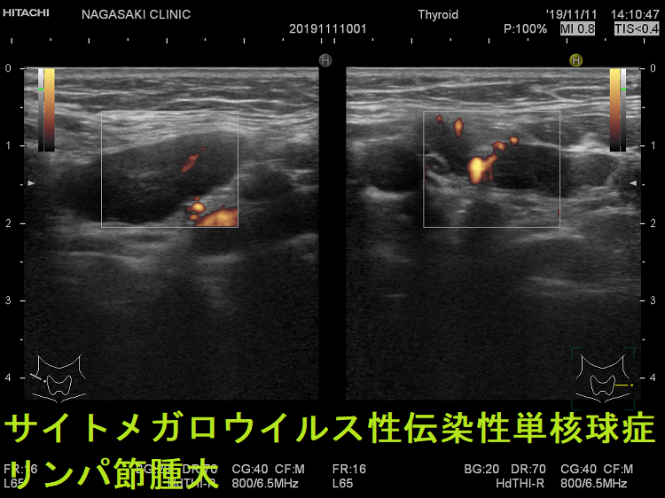 サイトメガロウイルス性伝染性単核球症 リンパ節腫大 超音波(エコー)画像(水平断) ドプラーモード サイトメガロウイルス性伝染性単核球症 リンパ節腫大 超音波(エコー)画像(水平断) ドプラーモード